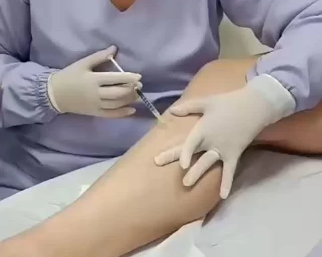 Escleroterapia (PEIM) aplicada pela Dra. Polianna