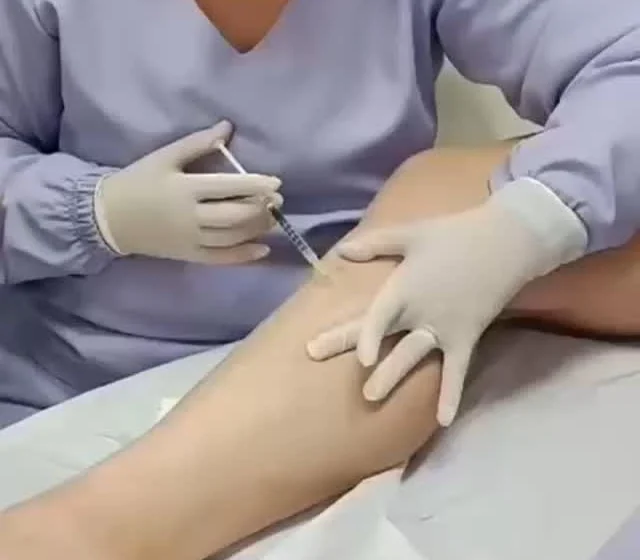 Mãos da Dra. Polianna aplicando escleroterapia por PEIM nos vasinhos da perna